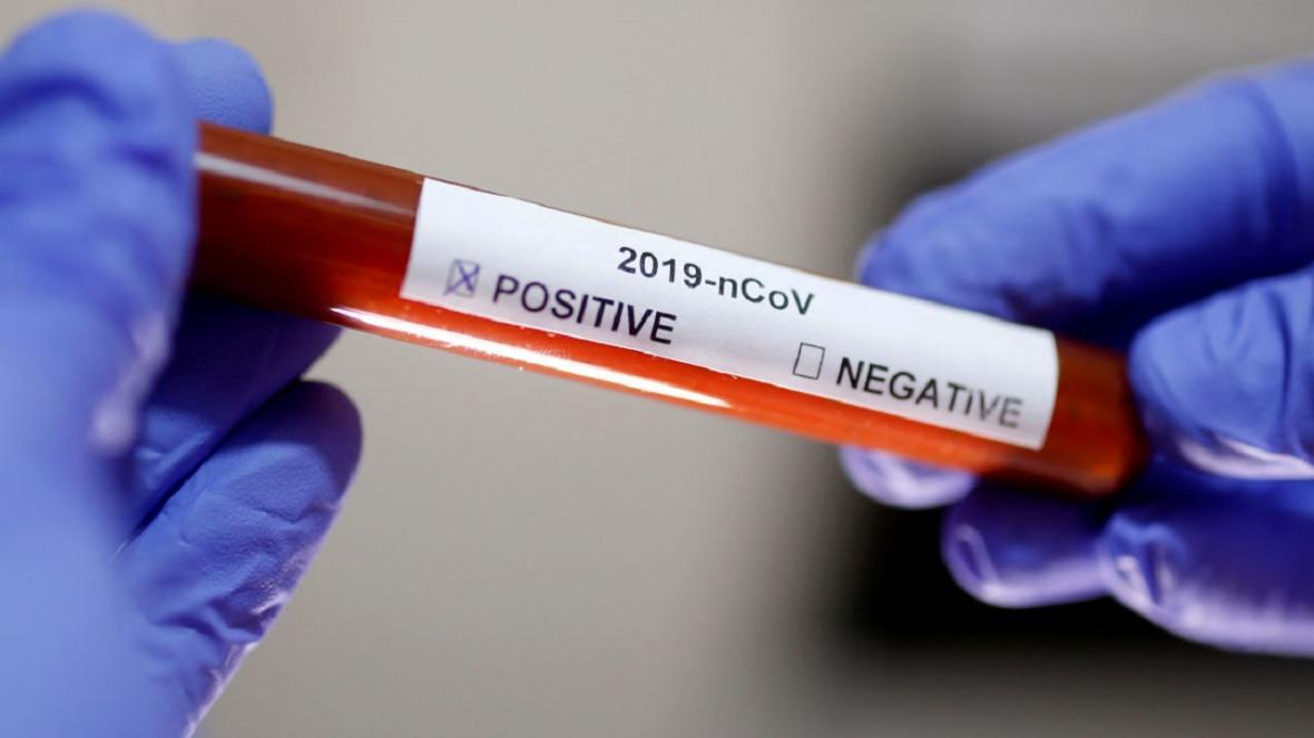 ویروس کرونا؛ تشخیص کووید 19 در عرض 20 دقیقه با کیت های آزمایش جدید